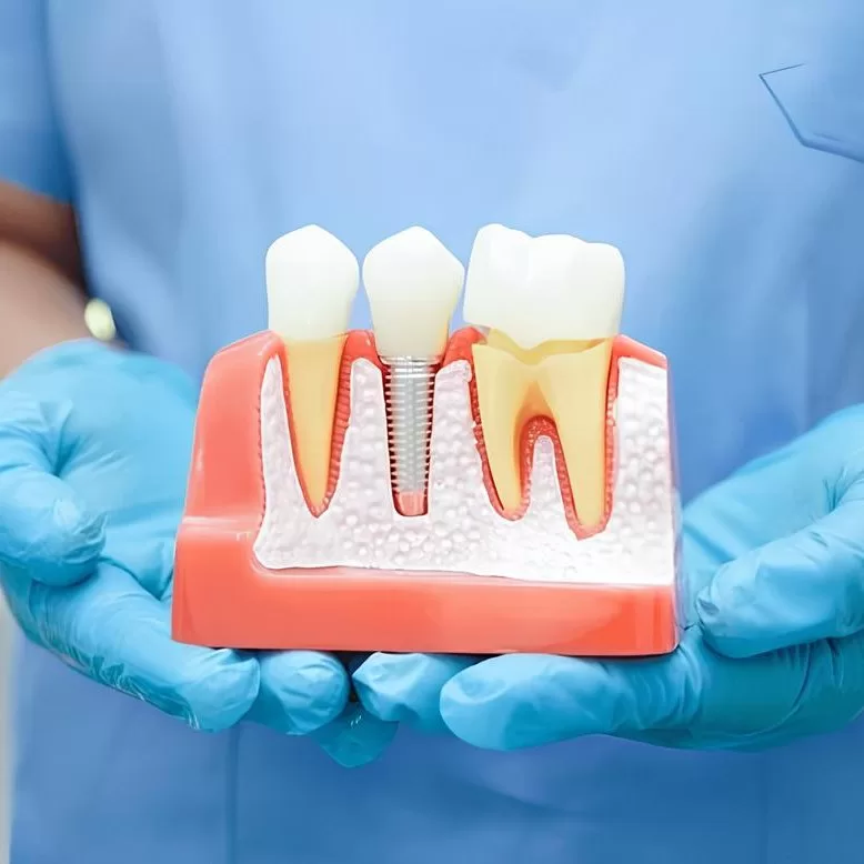 Dental Implants at Dr. Anuj Barolia's Dental Studio