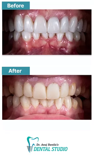 Clear Aligner Aesthetic Alignment - Before and After Result