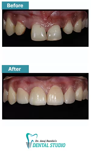 Deep Staining & In-Office Whitening - Before and After Result