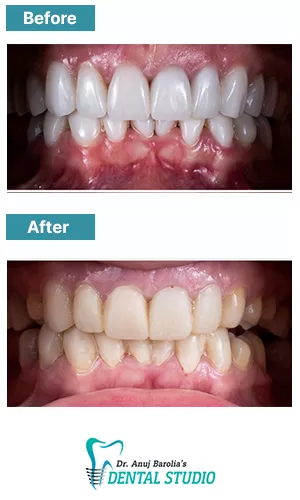 Anterior Tooth Replacement via Implant - Before and after clinical result at Dr. Anuj Barolia's studio