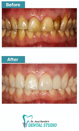 Full Arch Implant Restoration - Before and after clinical result at Dr. Anuj Barolia's studio