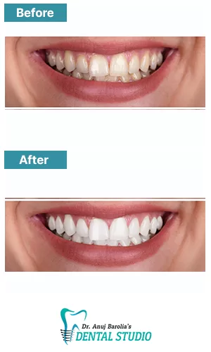 Cosmetic Veneer Smile Makeover - Before and after clinical result at Dr. Anuj Barolia's studio