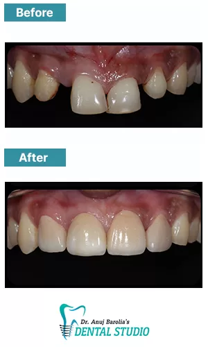 Severe Wear & Bite Reconstruction - Before and after clinical result at Dr. Anuj Barolia's studio